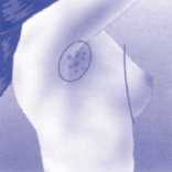 Radicale mammectomie