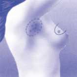 Tumorectomie en klieruitruiming